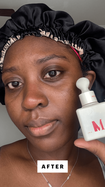 BlayTettey after applying the Dr. Diamonds Metacine Instafacial Plasma